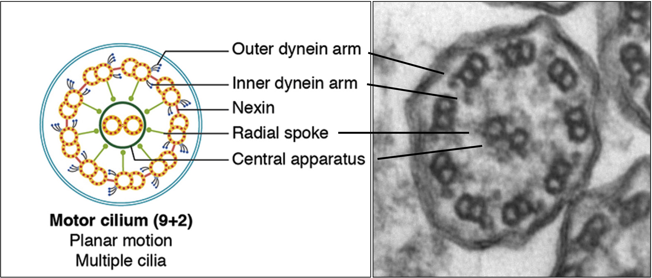Primary Ciliary Dyskinesia (PCD) – Exploring Pediatric Pathology